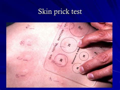 allergy skin test results chart|Skin Prick Testing Guide for Diagnosis of Allergic Disease.